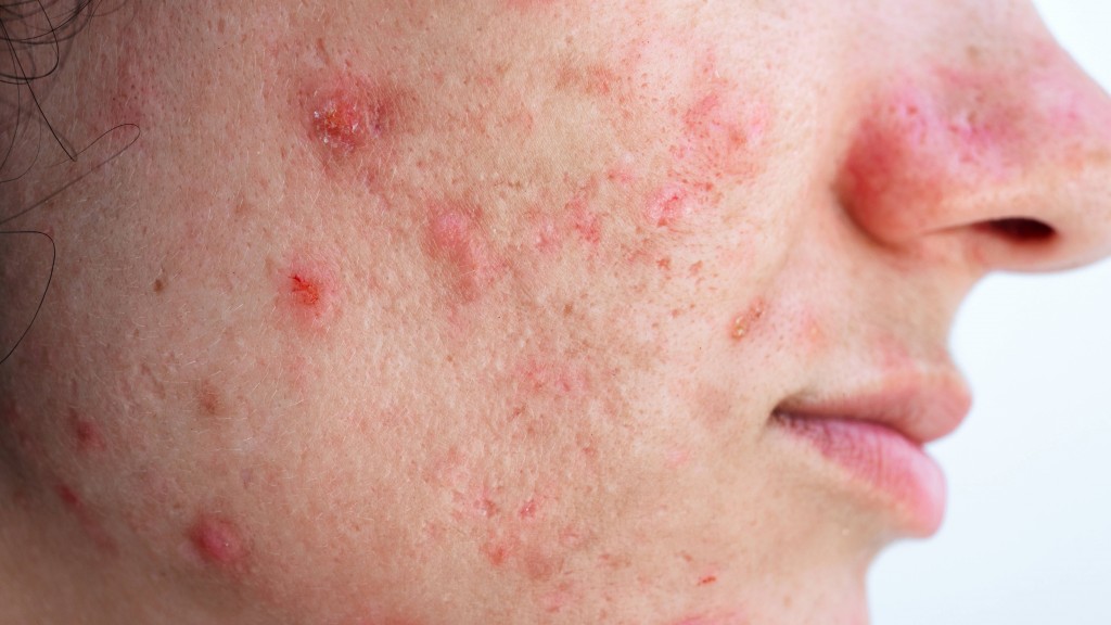 Anke-Pickel im Gesicht einer Frau