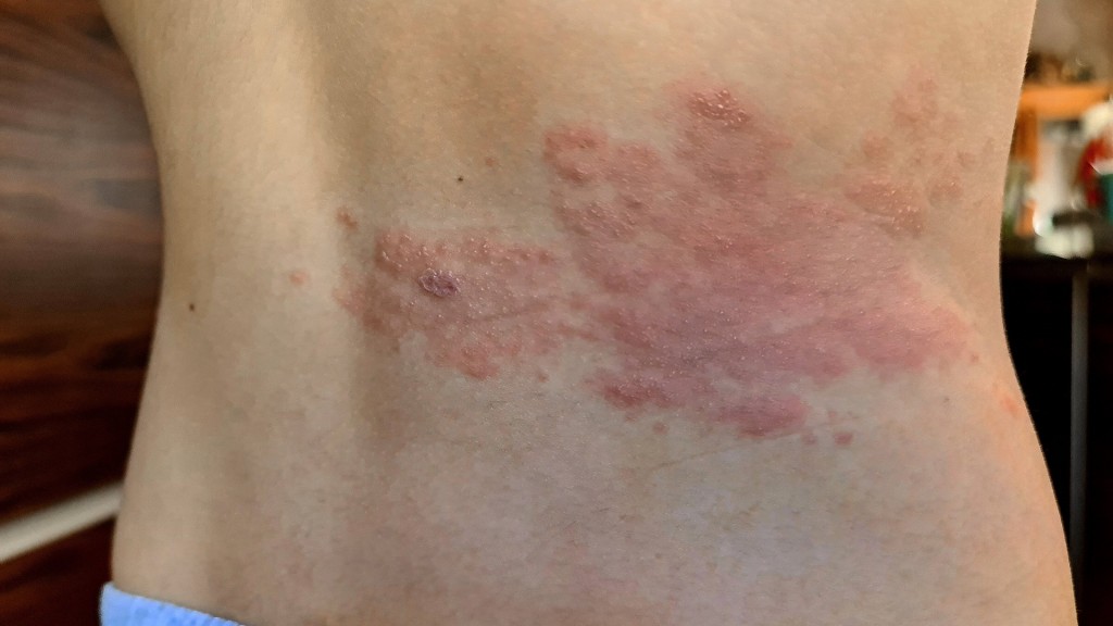 Gürtelrose am Rücken 